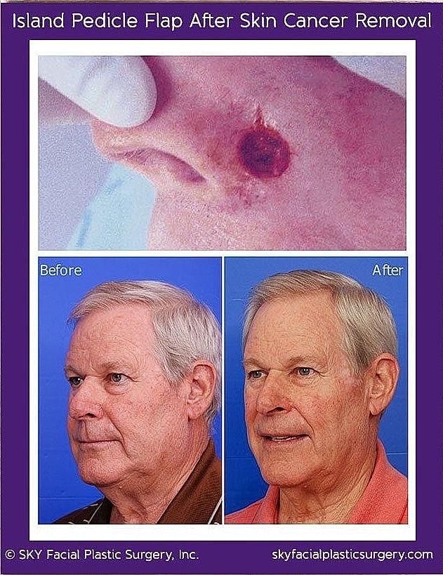 Mohs Reconstruction Before & After