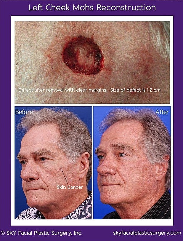 Mohs Reconstruction Before & After