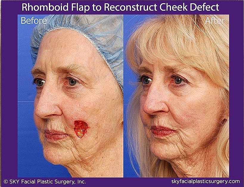 Mohs Reconstruction Before & After