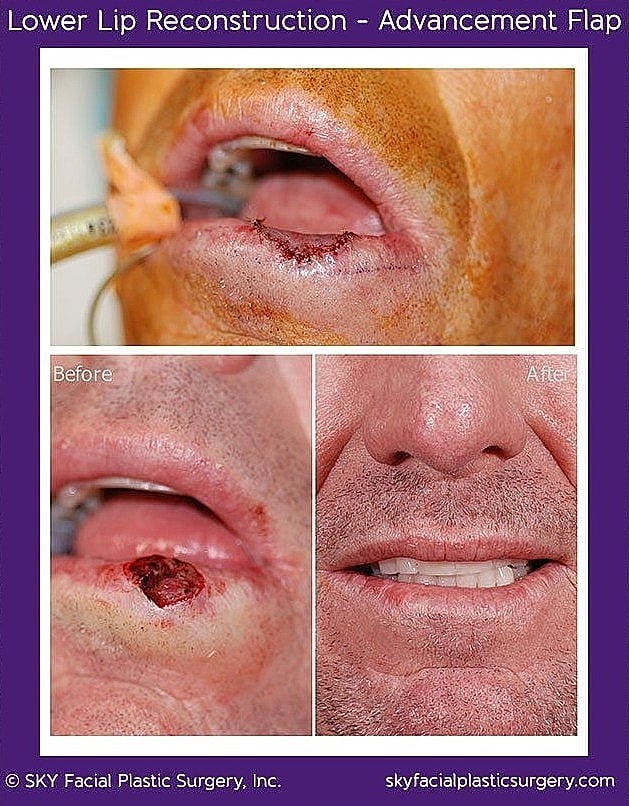 Mohs Reconstruction Before & After