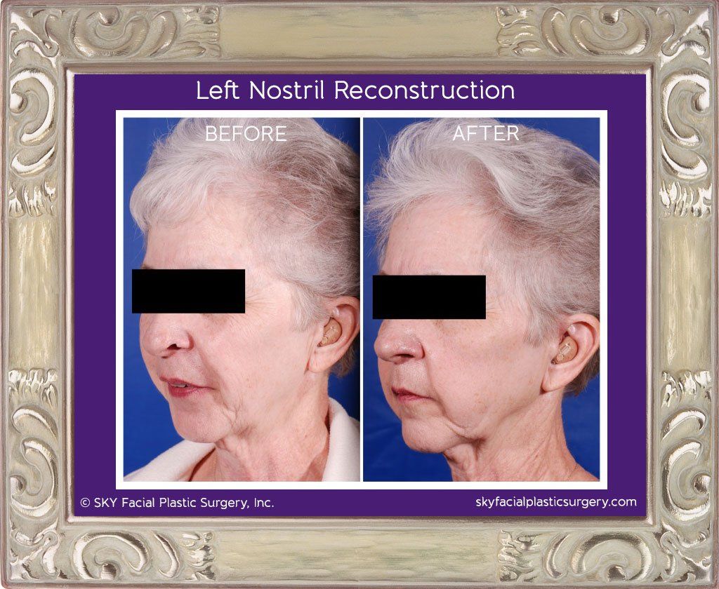 Mohs Reconstruction Before & After