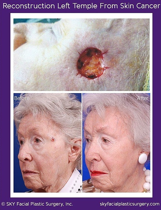 Mohs Reconstruction Before & After