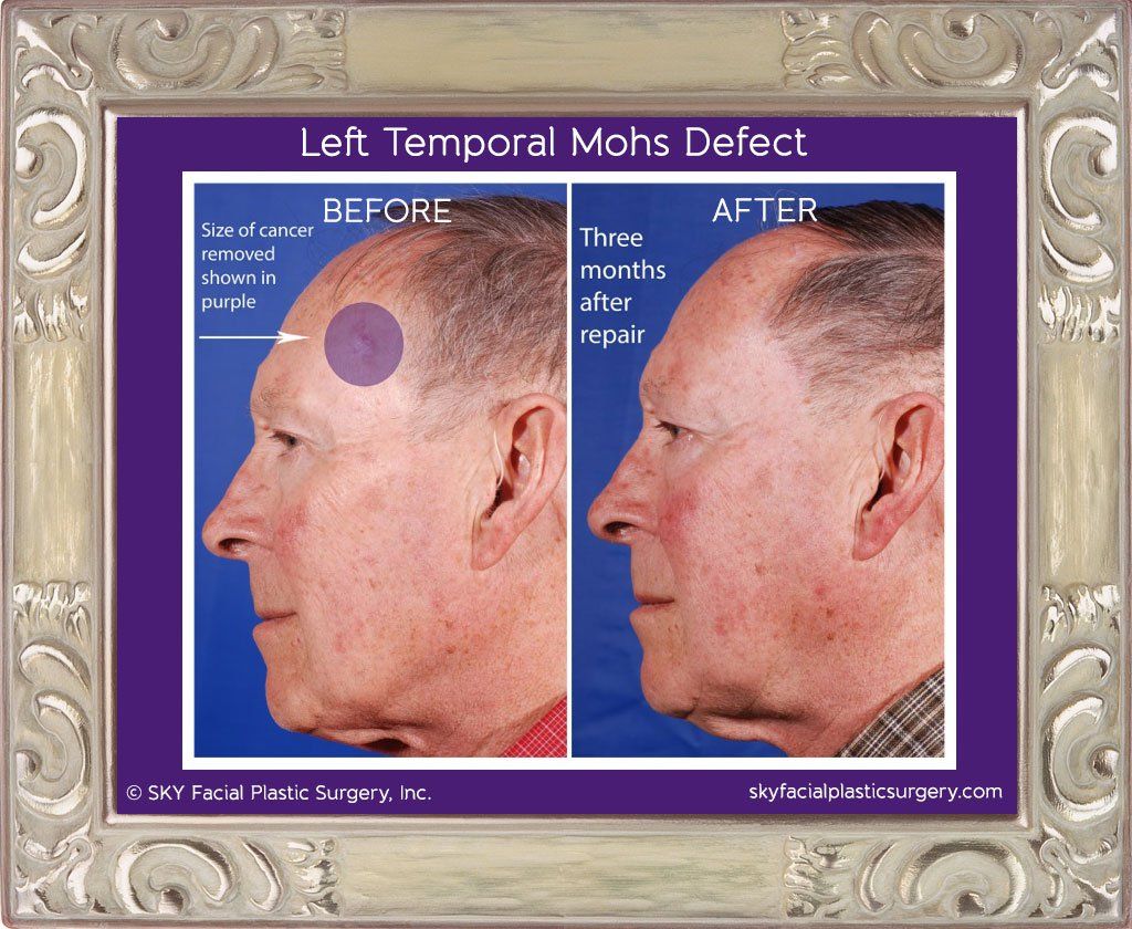 Mohs Reconstruction Before & After