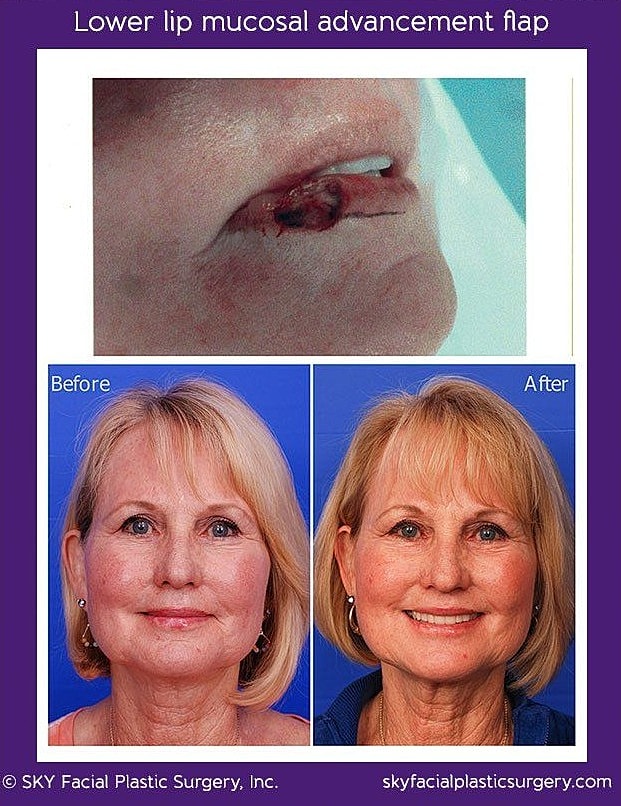 Mohs Reconstruction Before & After