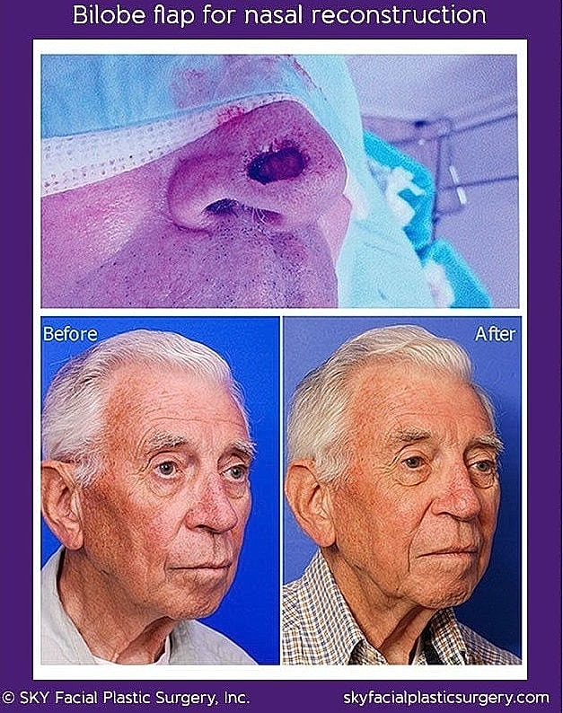 Mohs Reconstruction Before & After