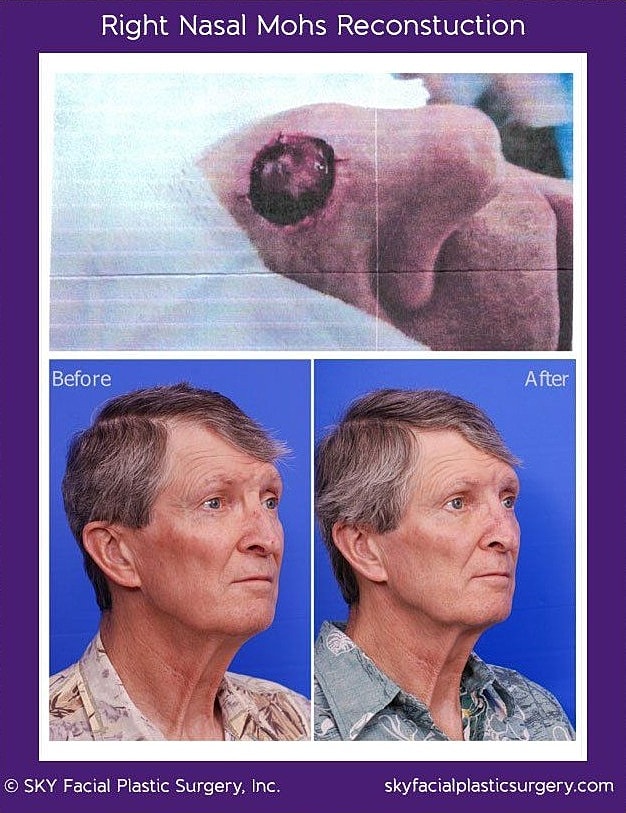 Mohs Reconstruction Before & After