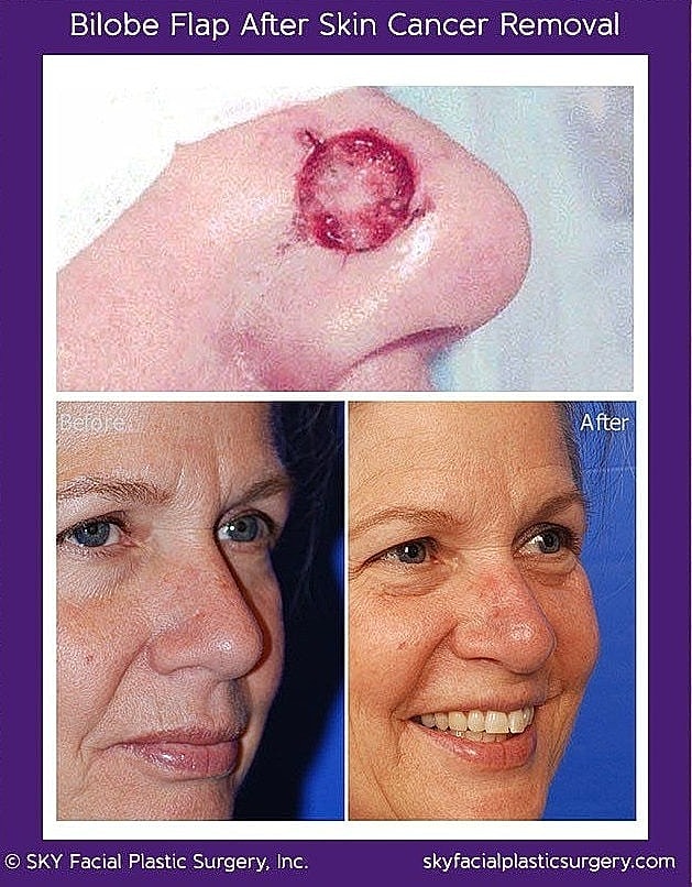 Mohs Reconstruction Before & After