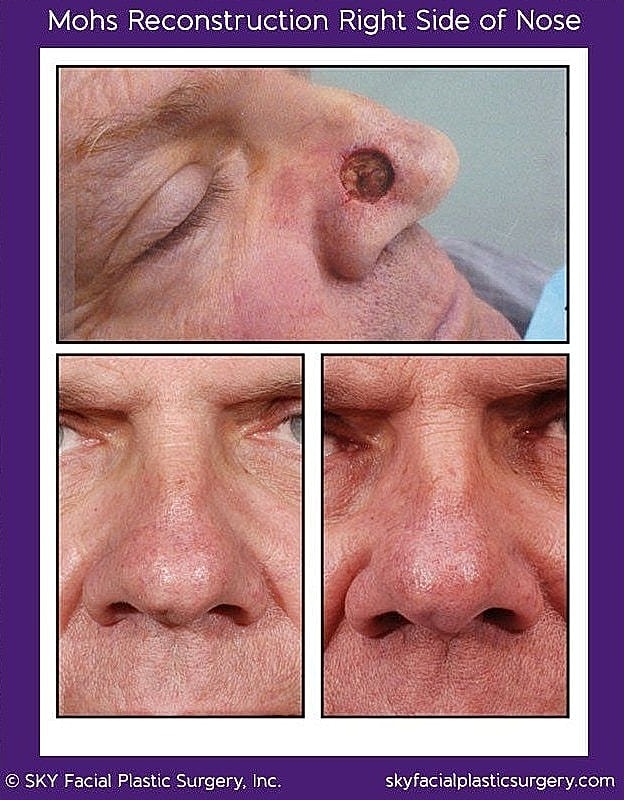Mohs Reconstruction Before & After