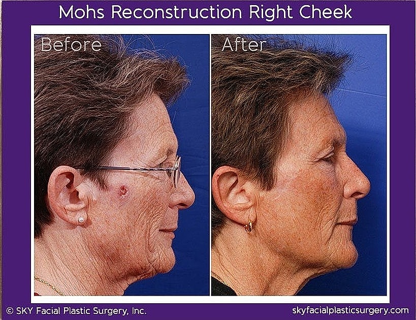 Mohs Reconstruction Before & After