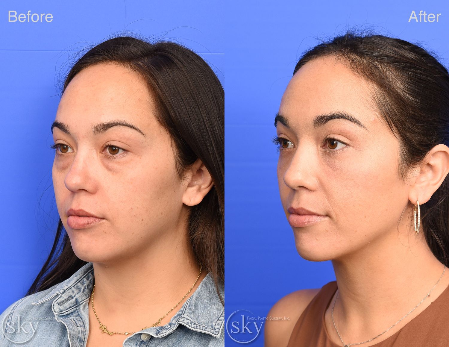 Blepharoplasty Before & After