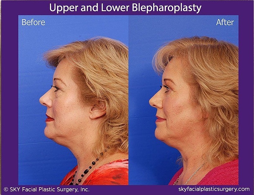 Blepharoplasty Before & After