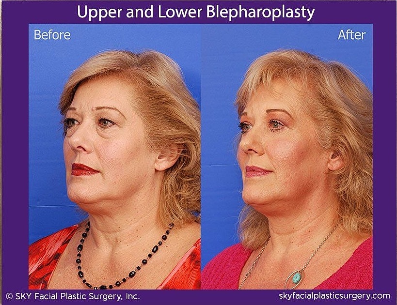 Blepharoplasty Before & After