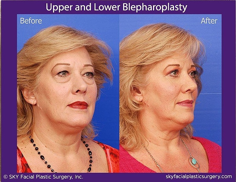 Blepharoplasty Before & After