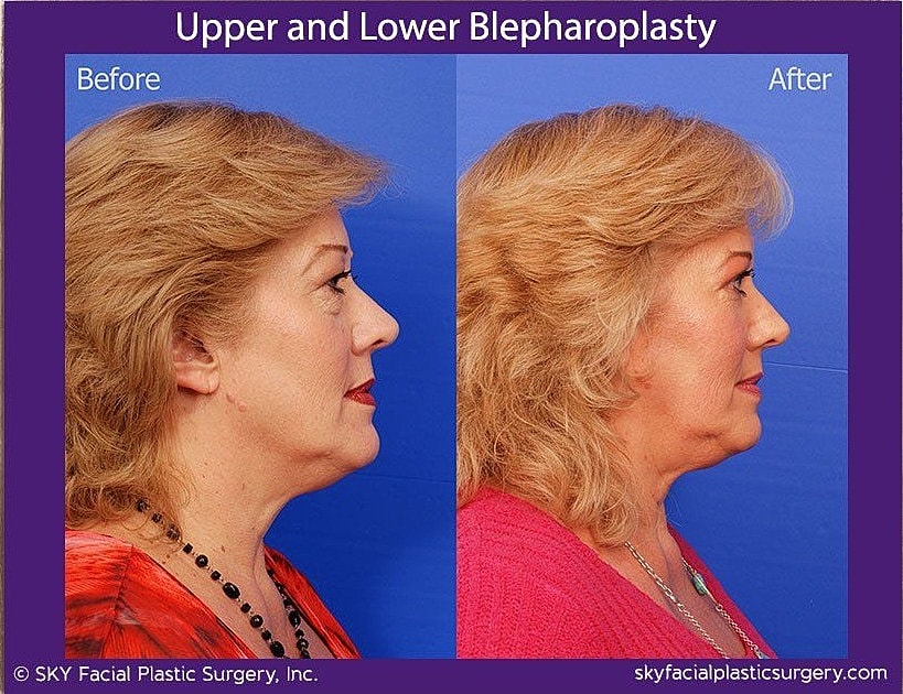 Blepharoplasty Before & After