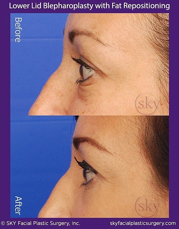 Blepharoplasty Before & After