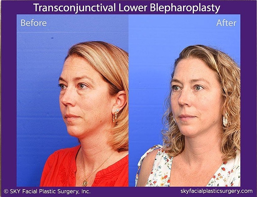 Blepharoplasty Before & After