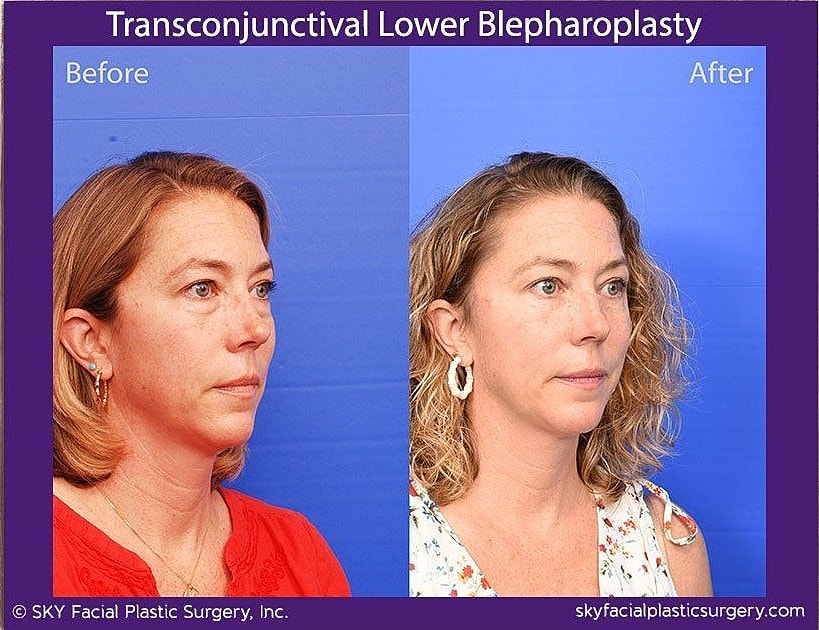 Blepharoplasty Before & After
