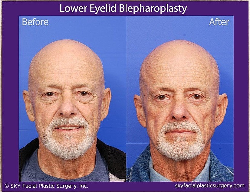 Blepharoplasty Before & After