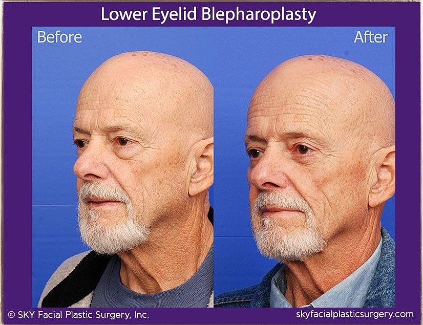 Blepharoplasty Before & After