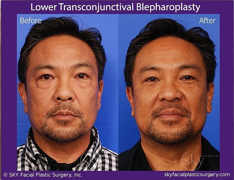 Blepharoplasty Before & After