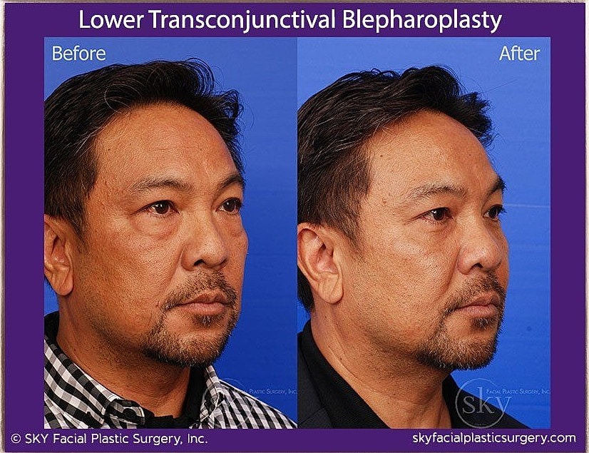 Blepharoplasty Before & After
