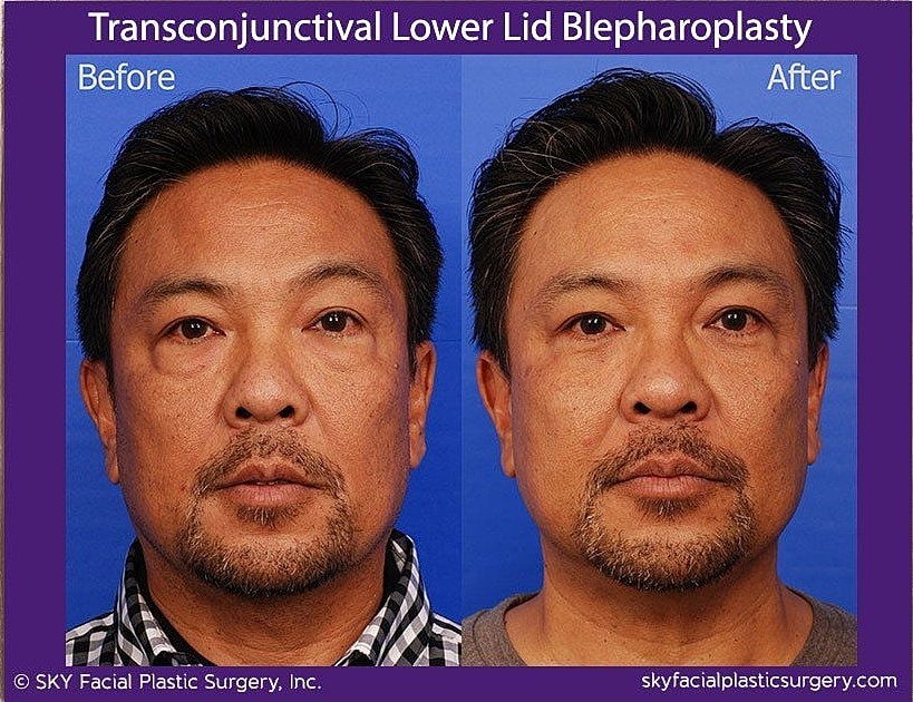 Blepharoplasty Before & After