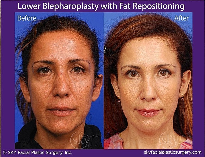 Blepharoplasty Before & After