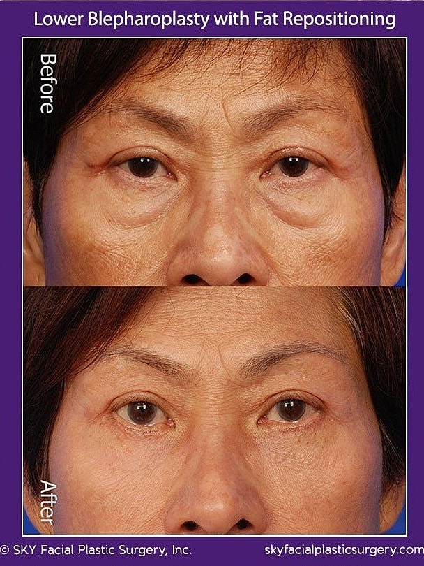 Blepharoplasty Before & After