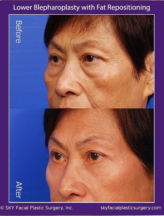 Blepharoplasty Before & After