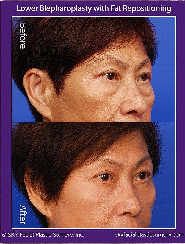 Blepharoplasty Before & After