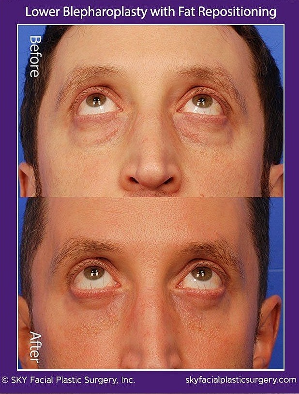 Blepharoplasty Before & After