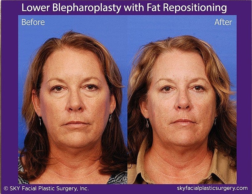 Blepharoplasty Before & After