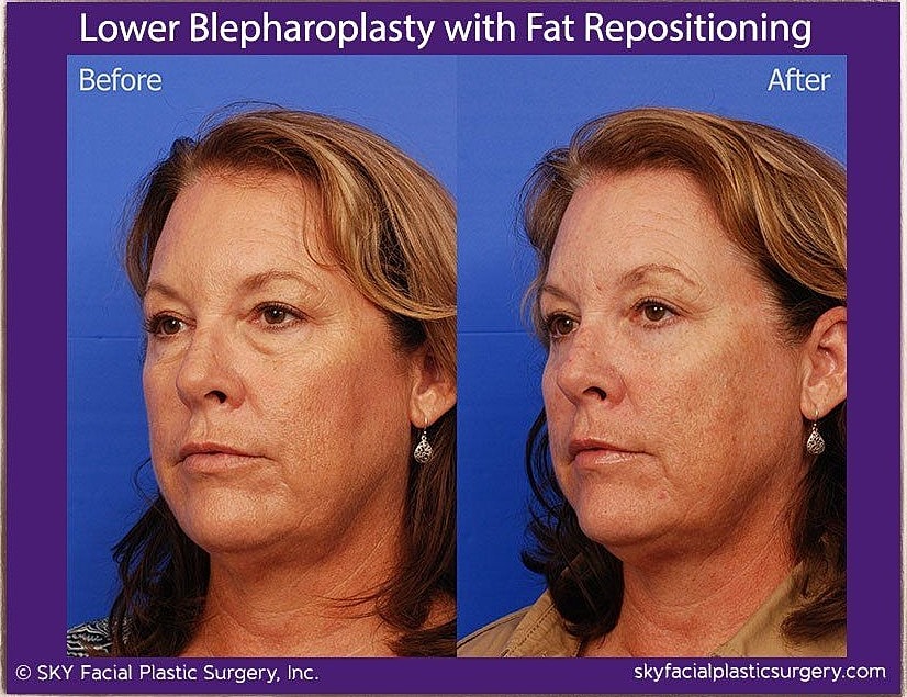 Blepharoplasty Before & After