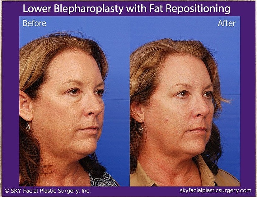 Blepharoplasty Before & After