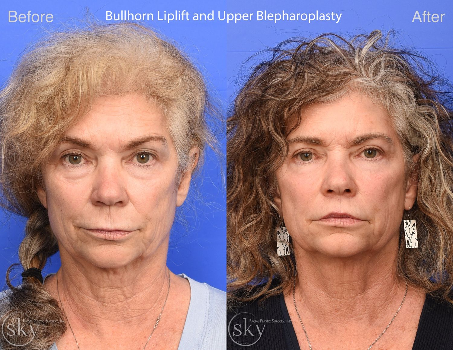 Blepharoplasty Before & After