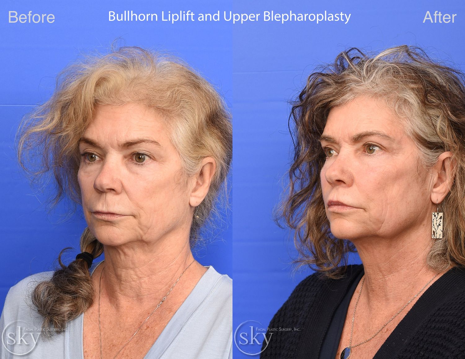 Blepharoplasty Before & After