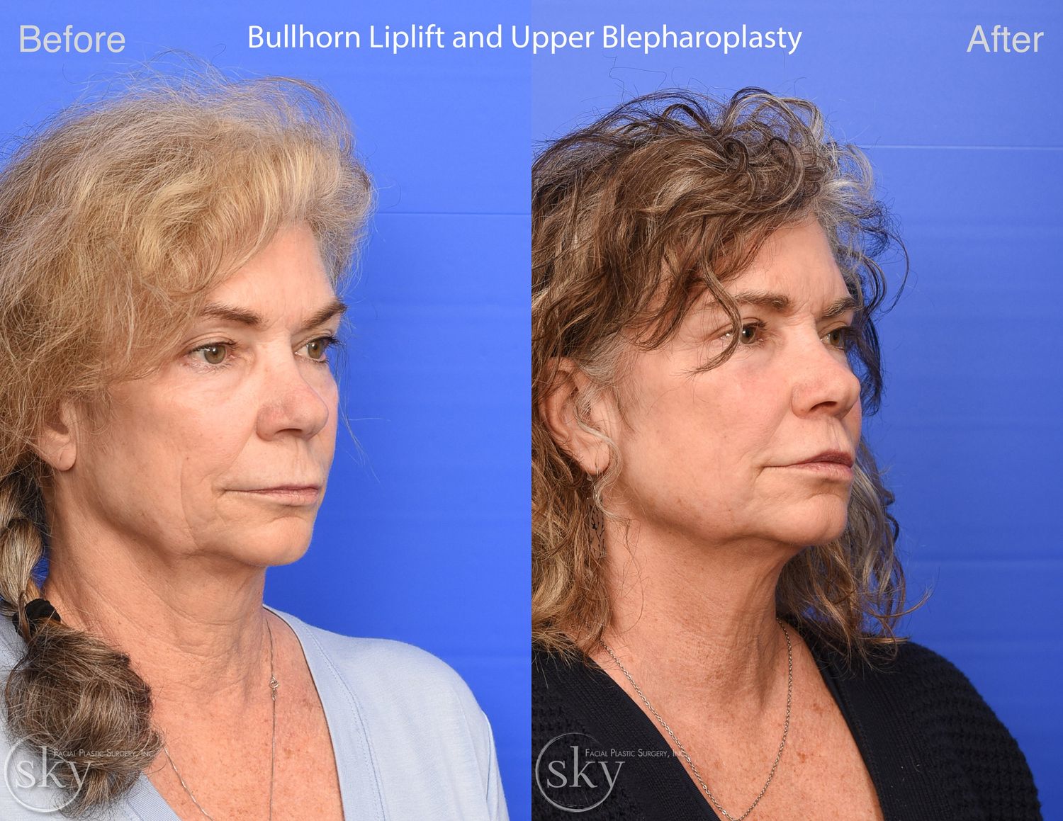 Blepharoplasty Before & After