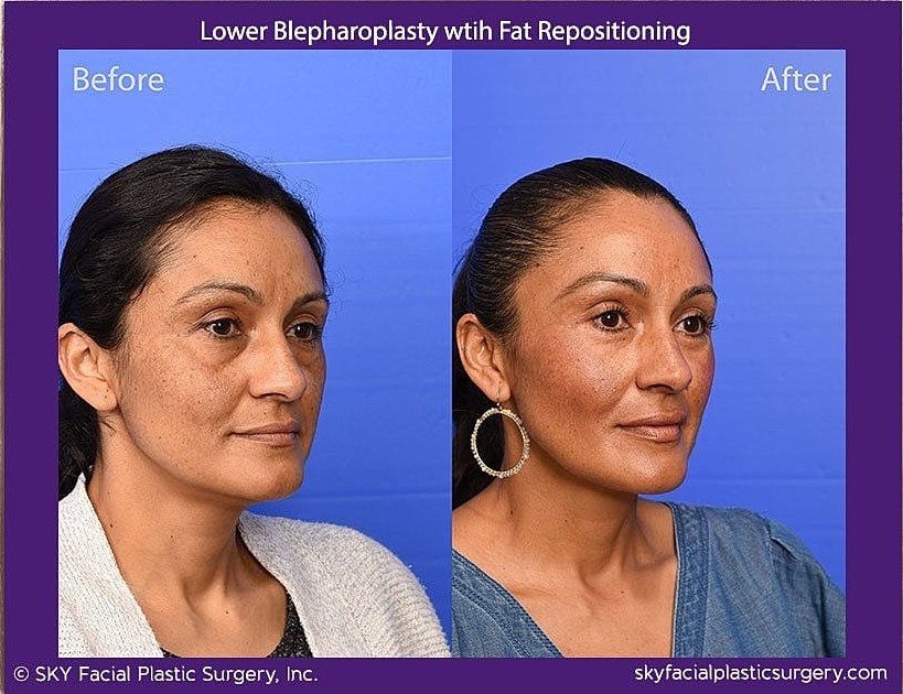 Blepharoplasty Before & After