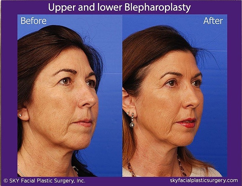 Blepharoplasty Before & After
