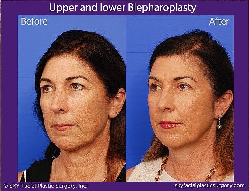 Blepharoplasty Before & After