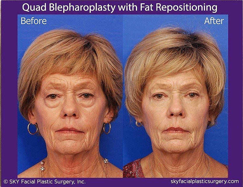 Blepharoplasty Before & After