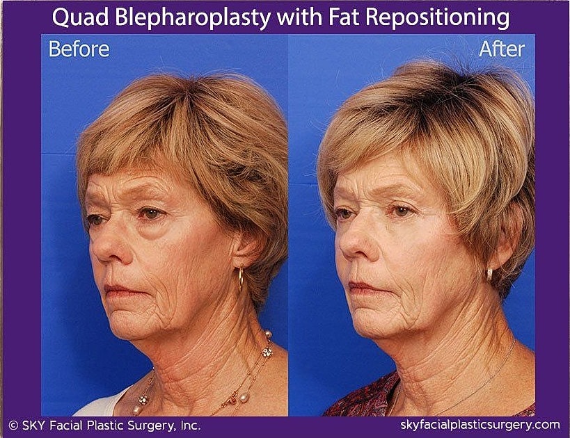 Blepharoplasty Before & After