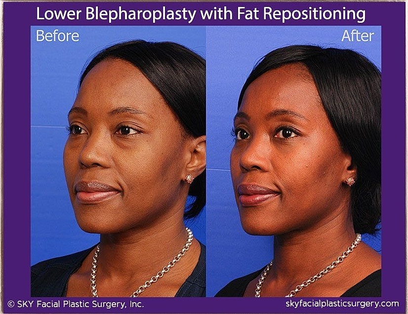 Blepharoplasty Before & After