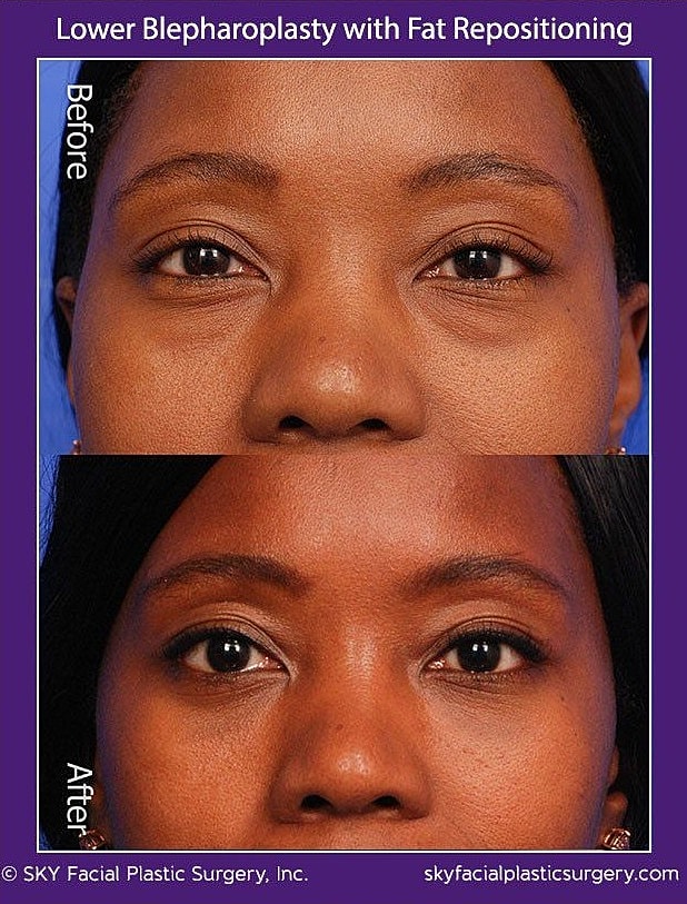 Blepharoplasty Before & After