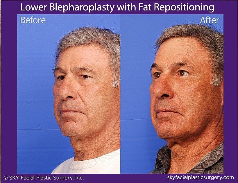 Blepharoplasty Before & After