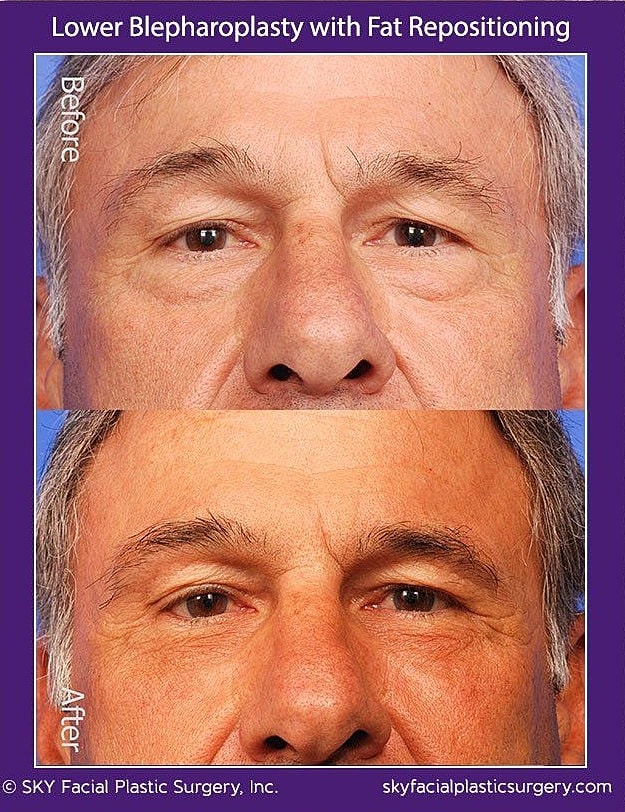 Blepharoplasty Before & After