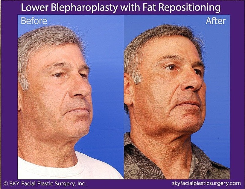 Blepharoplasty Before & After