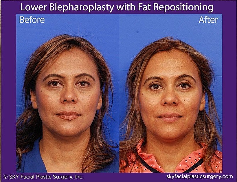 Blepharoplasty Before & After
