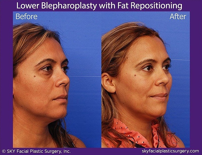Blepharoplasty Before & After