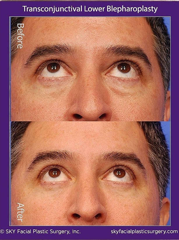 Blepharoplasty Before & After